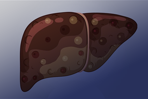 ‍ سيروز كبدی  (cirrhosis of liver)